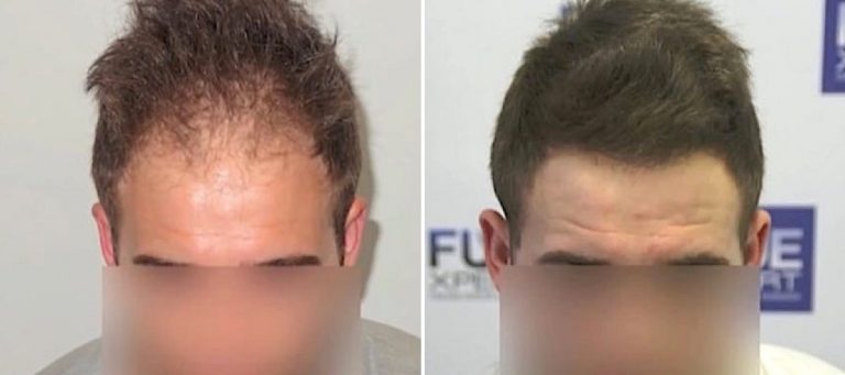 Antes y Después - 2400 Injertos - Trasplante capilar FUE - Dr Couto - FUExpert Clinic