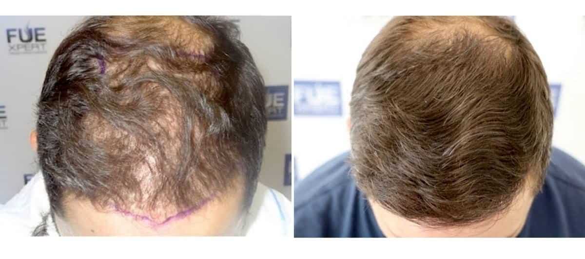 Antes y Después - 2400 Injertos- Trasplante capilar FUE - Dr Juan Couto en clínica capilar FUExpert Clinic - Madrid, España
