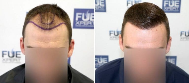 Antes y Después - 2705 Injertos- Trasplante capilar FUE - Dr Juan Couto en clínica capilar FUExpert Clinic - Madrid, España