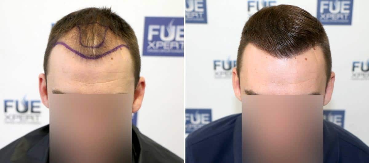 Antes y Después - 2705 Injertos- Trasplante capilar FUE - Dr Juan Couto en clínica capilar FUExpert Clinic - Madrid, España