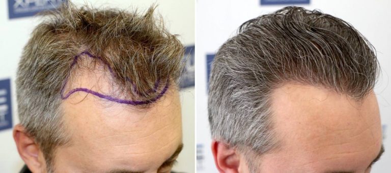 Antes y Después - 3044 Injertos- Trasplante capilar FUE - Dr Juan Couto en clínica capilar FUExpert Clinic - Madrid, España