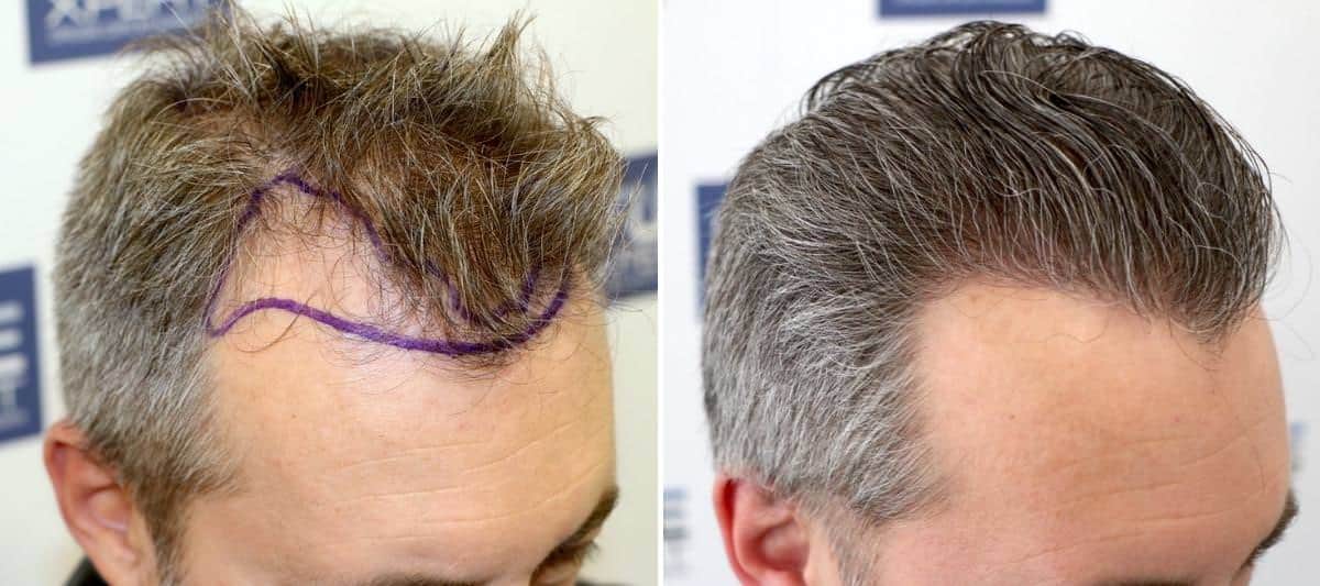 Antes y Después - 3044 Injertos- Trasplante capilar FUE - Dr Juan Couto en clínica capilar FUExpert Clinic - Madrid, España