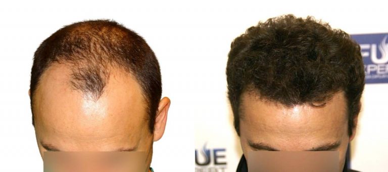 Antes y Después - 3235 Injertos- Trasplante capilar FUE - Dr Juan Couto en clínica capilar FUExpert Clinic - Madrid, España