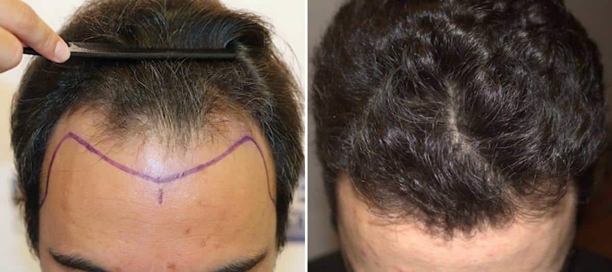 Antes y Después - 3500 Injertos- Trasplante capilar FUE - Dr Juan Couto en clínica capilar FUExpert Clinic - Madrid, España