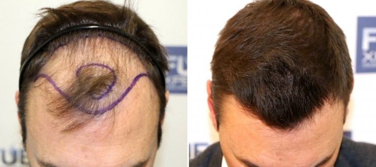 Antes y Después - 3500 Injertos- Trasplante capilar FUE - Dr Juan Couto en clínica capilar FUExpert Clinic - Madrid, España
