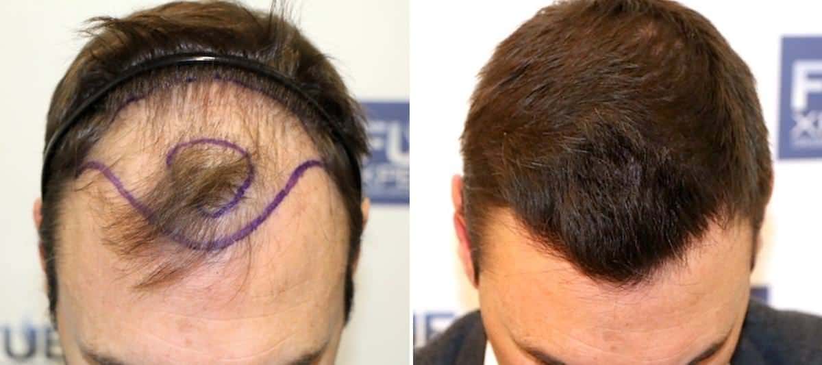 Antes y Después - 3500 Injertos- Trasplante capilar FUE - Dr Juan Couto en clínica capilar FUExpert Clinic - Madrid, España