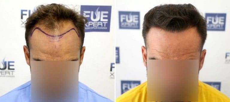 Antes y Después - 3600 Injertos- Trasplante capilar FUE - Dr Juan Couto en clínica capilar FUExpert Clinic - Madrid, España