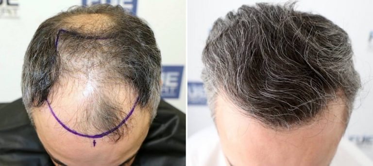 Antes y Después - 3700 Injertos- Trasplante capilar FUE - Dr Juan Couto en clínica capilar FUExpert Clinic - Madrid, España