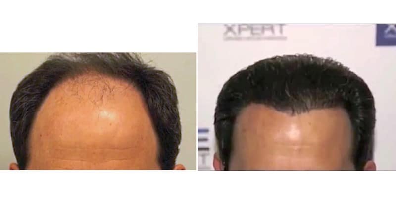 Antes y Después - 3752 Injertos - Trasplante capilar FUE - Dr Juan Couto en clínica capilar FUExpert Clinic
