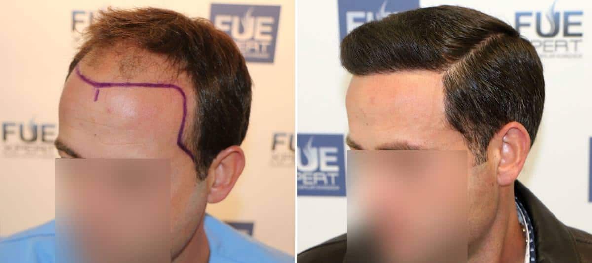 Antes y Después - 3958 Injertos- Trasplante capilar FUE - Dr Juan Couto en clínica capilar FUExpert Clinic - Madrid, España