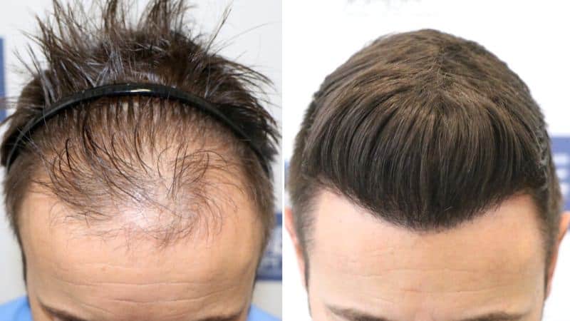 Antes Después 4275 Injertos - Trasplante Capilar FUE por el Dr Juan Couto en FUExpert Clinic en Madrid, España