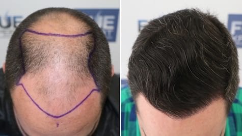 Antes Después 4766 Injertos FUE - Trasplante Capilar FUE por el Dr Juan Couto en FUExpert Clinic - Clínica Capilar en Madrid, España - Galería Videos