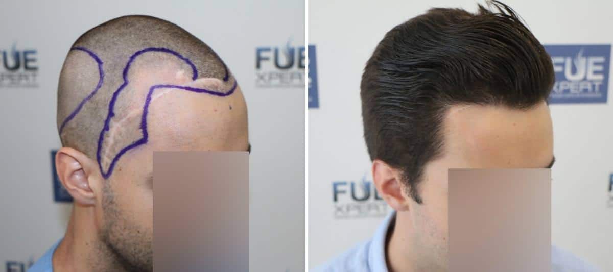 Caso 4, antes y después de injerto de primera línea y temples