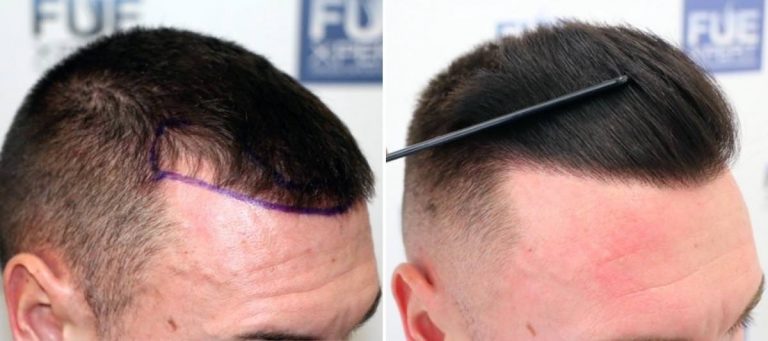 Antes y Después 1143 Injertos- Trasplante capilar FUE - Dr Juan Couto en clínica capilar FUExpert Clinic - Madrid, España