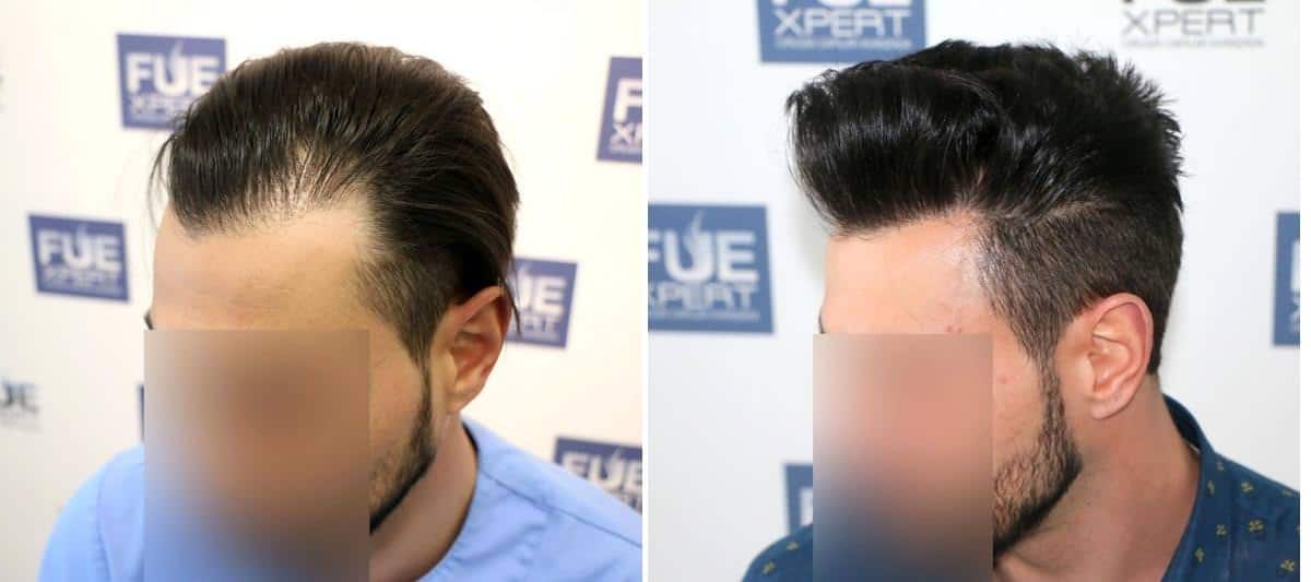 Antes y Después 1200 Injertos- Trasplante capilar FUE - Dr Juan Couto en clínica capilar FUExpert Clinic - Madrid, España