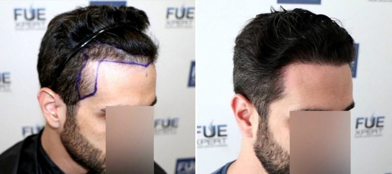 Antes y Después 1455 Injertos- Trasplante capilar FUE - Dr Juan Couto en clínica capilar FUExpert Clinic - Madrid, España