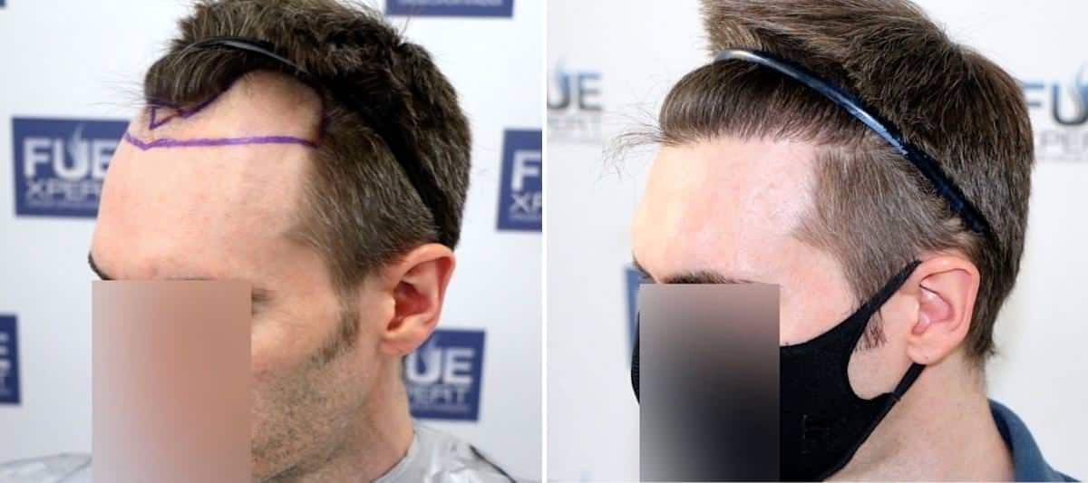 Antes y Después 1500 Injertos- Trasplante capilar FUE - Dr Juan Couto en clínica capilar FUExpert Clinic - Madrid, España