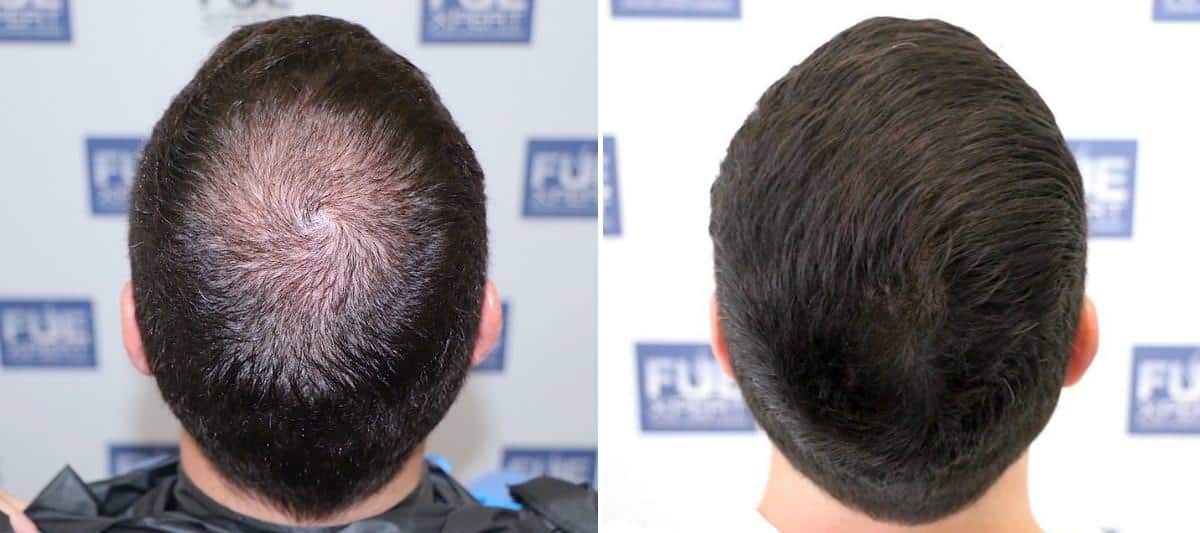 Antes y Después 1500 Injertos- Trasplante capilar FUE - Dr Juan Couto en clínica capilar FUExpert Clinic - Madrid, España