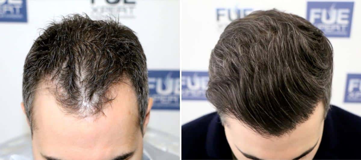 Antes y Después 1500 Injertos- Trasplante capilar FUE - Dr Juan Couto en clínica capilar FUExpert Clinic - Madrid, España
