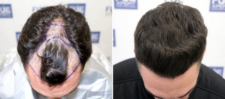 Antes y Después 1584 Injertos- Trasplante capilar FUE - Dr Juan Couto en clínica capilar FUExpert Clinic - Madrid, España