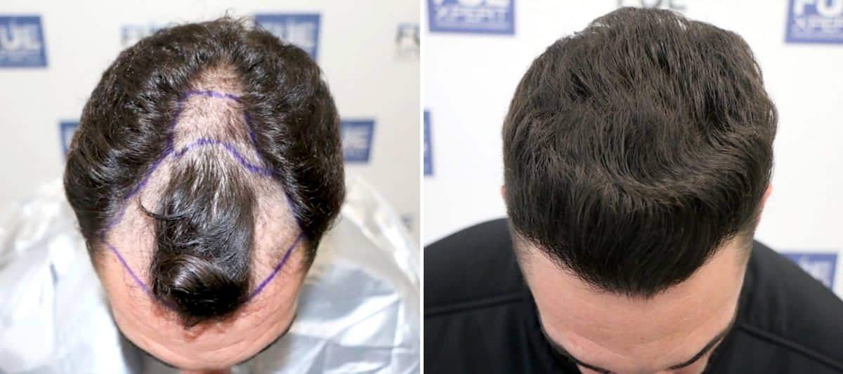 Antes y Después 1584 Injertos- Trasplante capilar FUE - Dr Juan Couto en clínica capilar FUExpert Clinic - Madrid, España