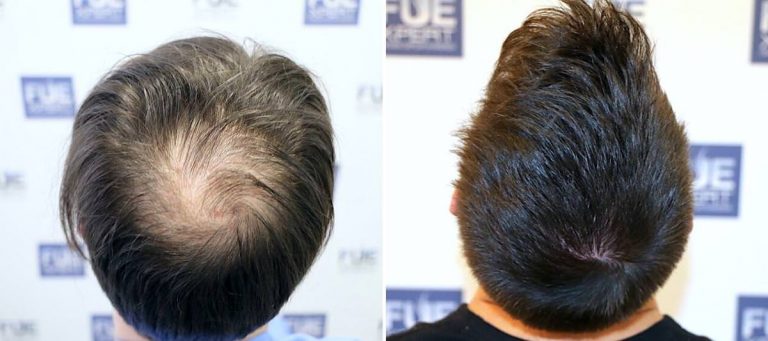 Antes y Después 1600 Injertos- Trasplante capilar FUE - Dr Juan Couto en clínica capilar FUExpert Clinic - Madrid, España