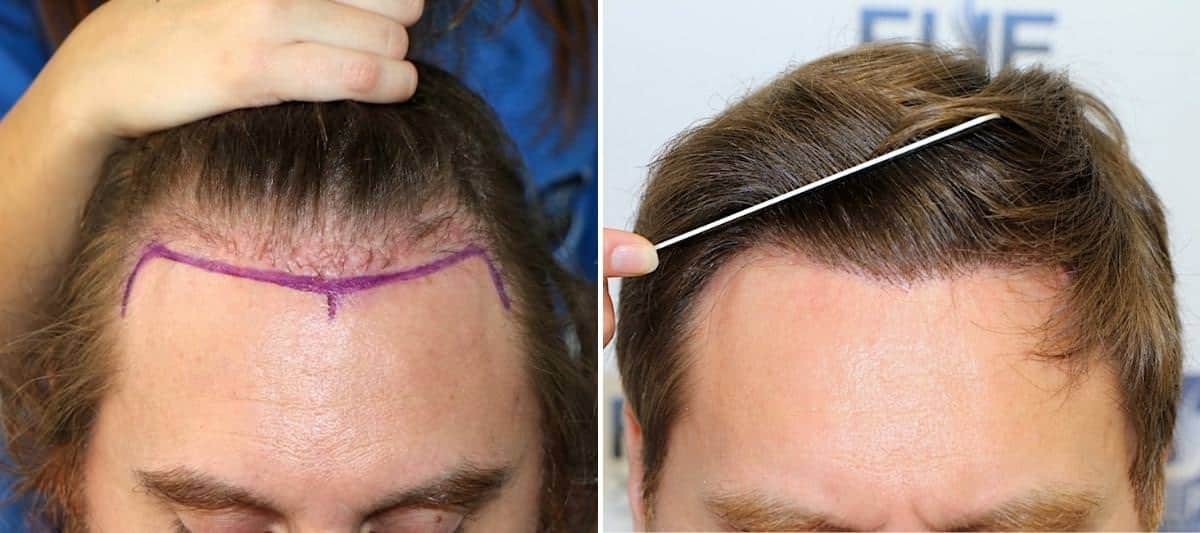 Antes y Después 1600 Injertos- Trasplante capilar FUE - Dr Juan Couto en clínica capilar FUExpert Clinic - Madrid, España