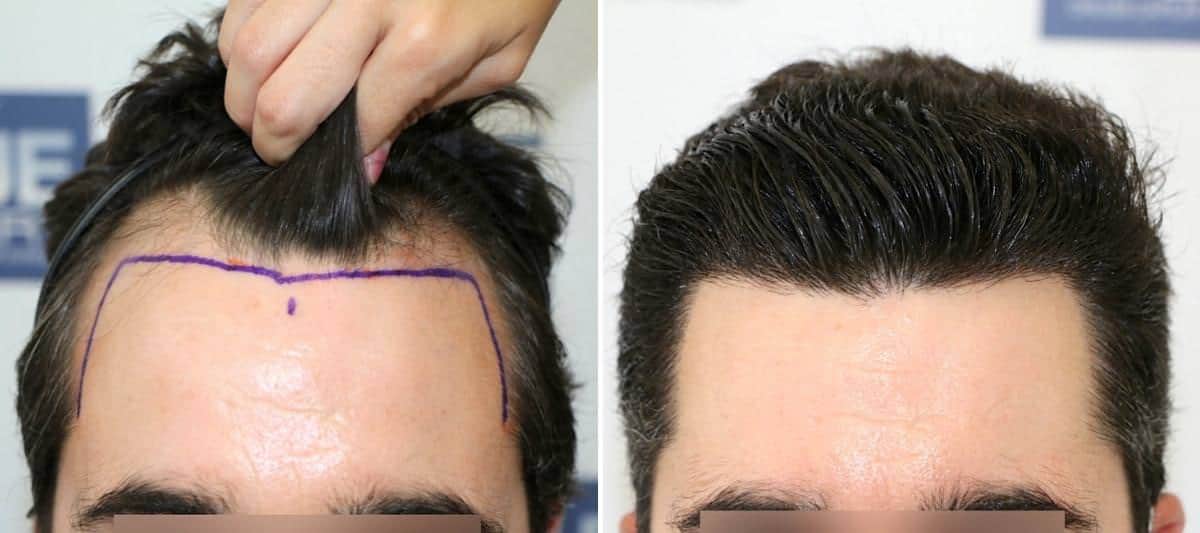 Antes y Después 1727 Injertos- Trasplante capilar FUE - Dr Juan Couto en clínica capilar FUExpert Clinic - Madrid, España
