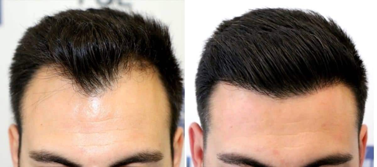 Antes y Después 1737 Injertos- Trasplante capilar FUE - Dr Juan Couto en clínica capilar FUExpert Clinic - Madrid, España