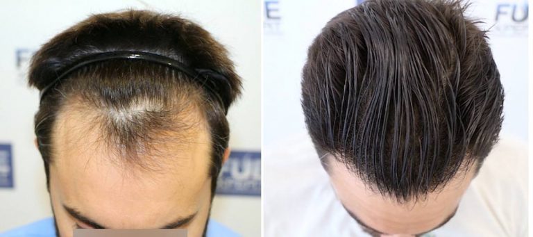 Antes y Después - 1778 Injertos- Trasplante capilar FUE - Dr Juan Couto en clínica capilar FUExpert Clinic - Madrid, España