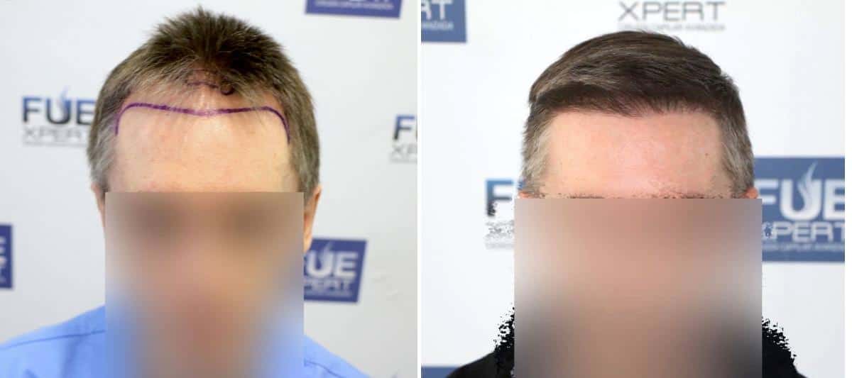 Antes y Después 1786 Injertos- Trasplante capilar FUE - Dr Juan Couto en clínica capilar FUExpert Clinic - Madrid, España