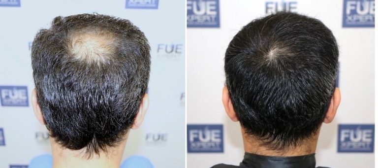 Antes y Después 1810 Injertos- Trasplante capilar FUE - Dr Juan Couto en clínica capilar FUExpert Clinic - Madrid, España