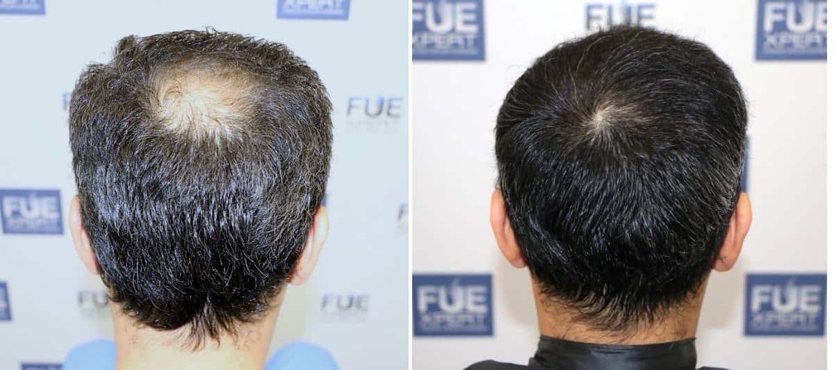 Antes y Después 1810 Injertos- Trasplante capilar FUE - Dr Juan Couto en clínica capilar FUExpert Clinic - Madrid, España