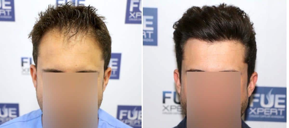 Antes y Después 2000 Injertos- Trasplante capilar FUE - Dr Juan Couto en clínica capilar FUExpert Clinic - Madrid, España