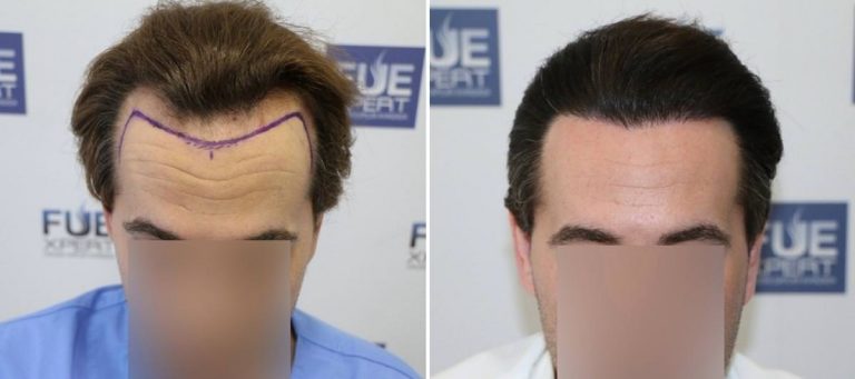 Antes y Después 2000 Injertos- Trasplante capilar FUE - Dr Juan Couto en clínica capilar FUExpert Clinic - Madrid, España