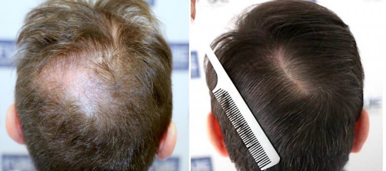 Antes y Después 2000 Injertos- Trasplante capilar FUE - Dr Juan Couto en clínica capilar FUExpert Clinic - Madrid, España