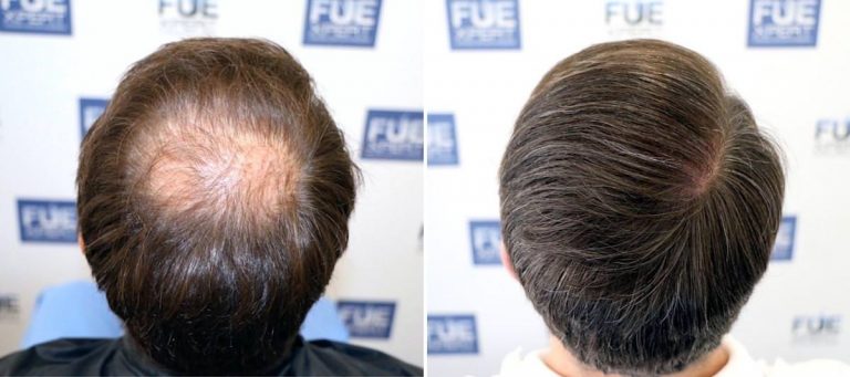 Antes y Después 2010 Injertos- Trasplante capilar FUE - Dr Juan Couto en clínica capilar FUExpert Clinic - Madrid, España