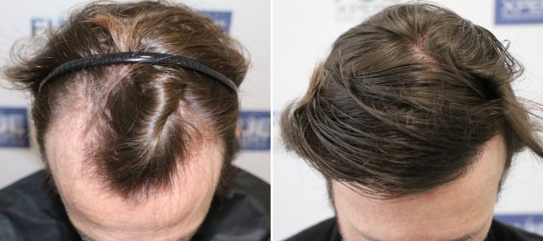 Antes y Después 2012 Injertos- Trasplante capilar FUE - Dr Juan Couto en clínica capilar FUExpert Clinic - Madrid, España