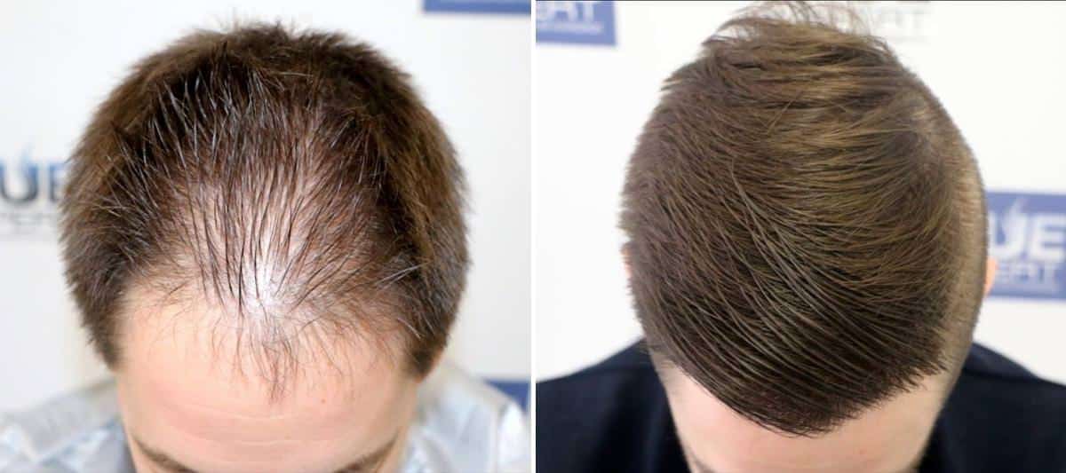 Antes y Después 2046 Injertos- Trasplante capilar FUE - Dr Juan Couto en clínica capilar FUExpert Clinic - Madrid, España