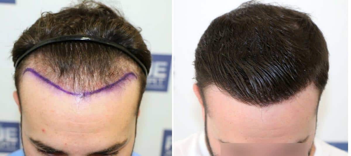 Antes y Después - 2126 Injertos- Trasplante capilar FUE - Dr Juan Couto en clínica capilar FUExpert Clinic - Madrid, España