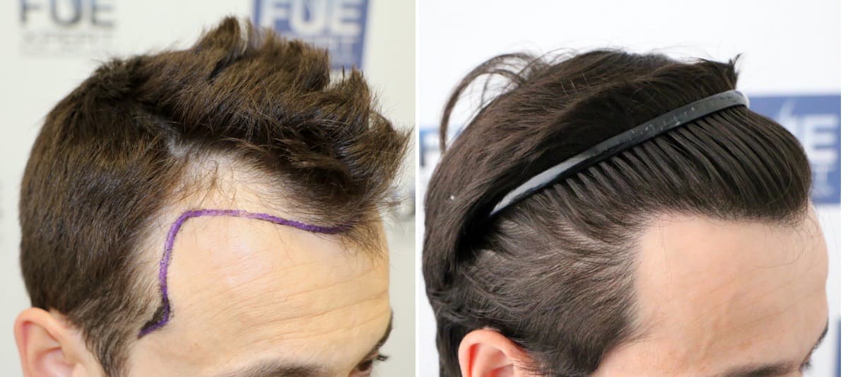 Antes y Después 2150 Injertos- Trasplante capilar FUE - Dr Juan Couto en clínica capilar FUExpert Clinic - Madrid, España