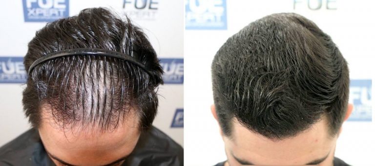 Antes y Después 2200 Injertos- Trasplante capilar FUE - Dr Juan Couto en clínica capilar FUExpert Clinic - Madrid, España