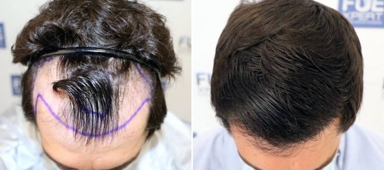 Antes y Después 2200 Injertos- Trasplante capilar FUE - Dr Juan Couto en clínica capilar FUExpert Clinic - Madrid, España
