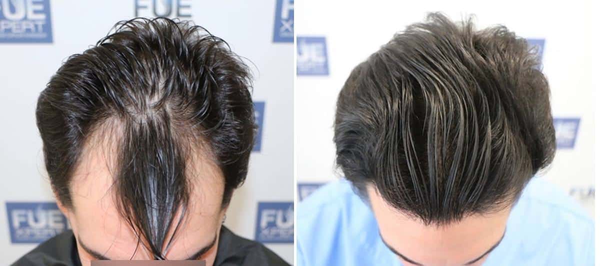 Antes y Después 2200 Injertos- Trasplante capilar FUE - Dr Juan Couto en clínica capilar FUExpert Clinic - Madrid, España