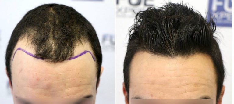 Antes y Después - 2218 Injertos- Trasplante capilar FUE - Dr Juan Couto en clínica capilar FUExpert Clinic - Madrid, España