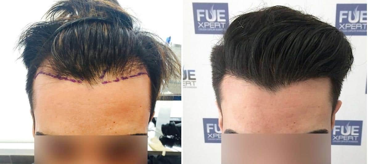 Antes y Después 2224 Injertos- Trasplante capilar FUE - Dr Juan Couto en clínica capilar FUExpert Clinic - Madrid, España