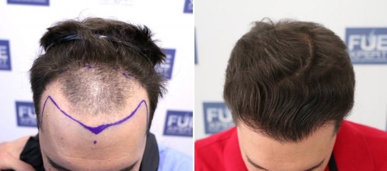 Antes y Después 2309 Injertos- Trasplante capilar FUE - Dr Juan Couto en clínica capilar FUExpert Clinic - Madrid, España