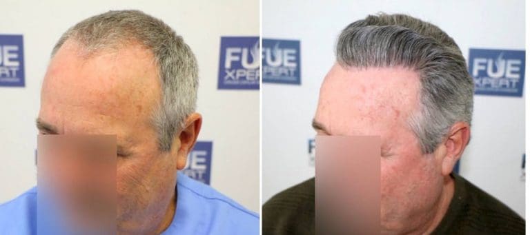 Antes y Después - 2400 Injertos- Trasplante capilar FUE - Dr Juan Couto en clínica capilar FUExpert Clinic - Madrid, España