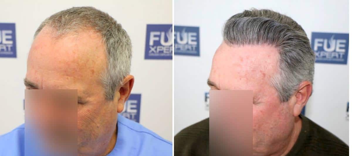 Antes y Después - 2400 Injertos- Trasplante capilar FUE - Dr Juan Couto en clínica capilar FUExpert Clinic - Madrid, España