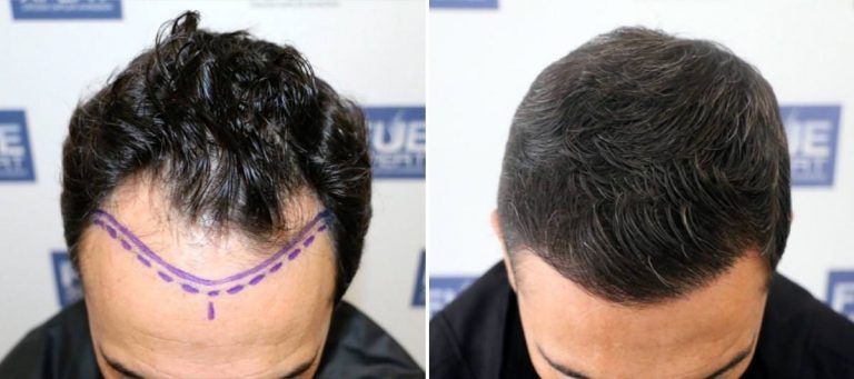 Antes y Después 2444 Injertos- Trasplante capilar FUE - Dr Juan Couto en clínica capilar FUExpert Clinic - Madrid, España